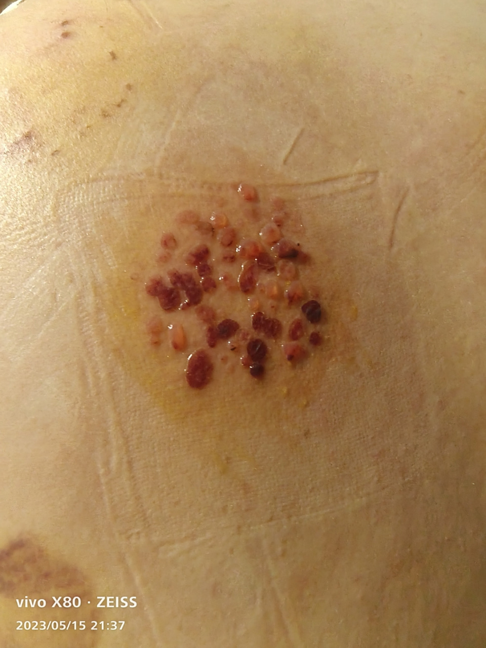 拔罐后起泡啦,前几天又疼又痒,现在是非常痒,不知道用什么药,只用碘伏