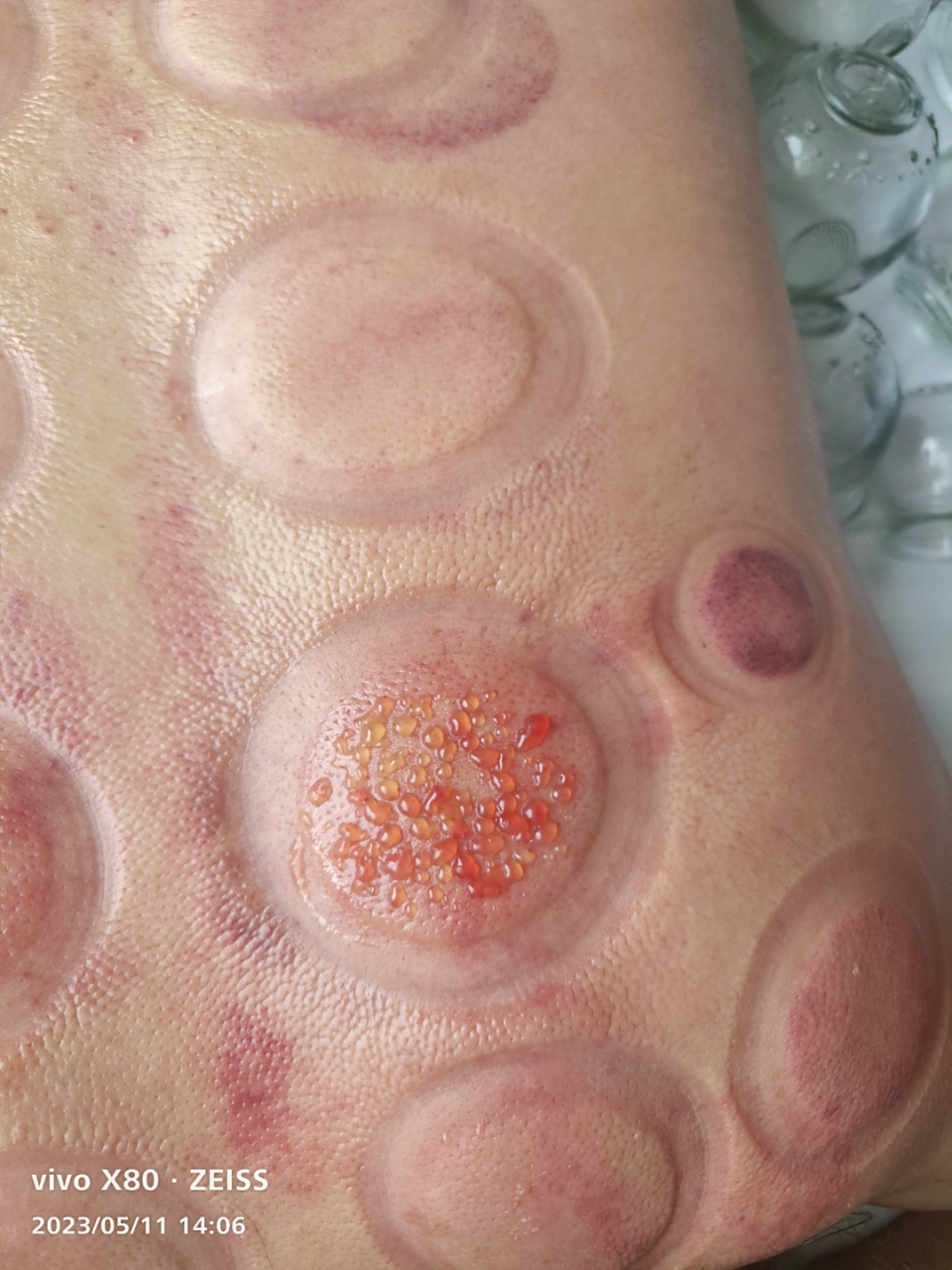 拔罐后起泡啦,前几天又疼又痒,现在是非常痒,不知道用什么药,只用碘伏