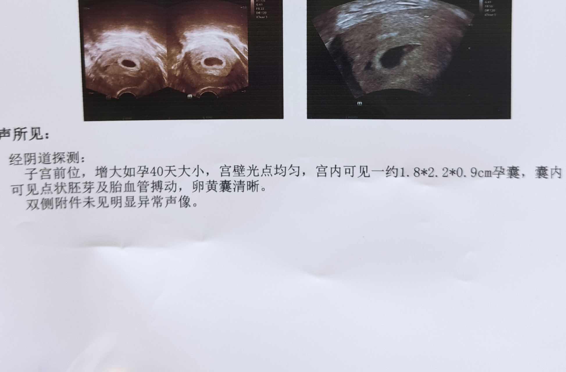 怀孕四十多天孕囊1.8*2.2*0.9,请问是男孩还是女孩?