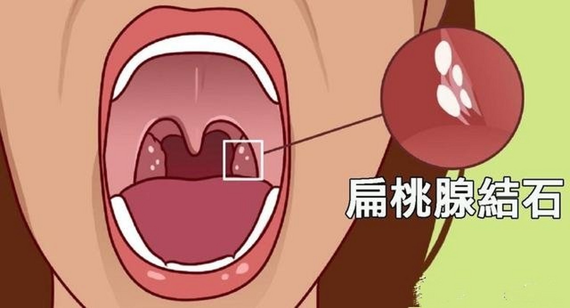 扁桃体结石对很多人有一点陌生,很多人就疑惑了:"有胆结石,尿结石