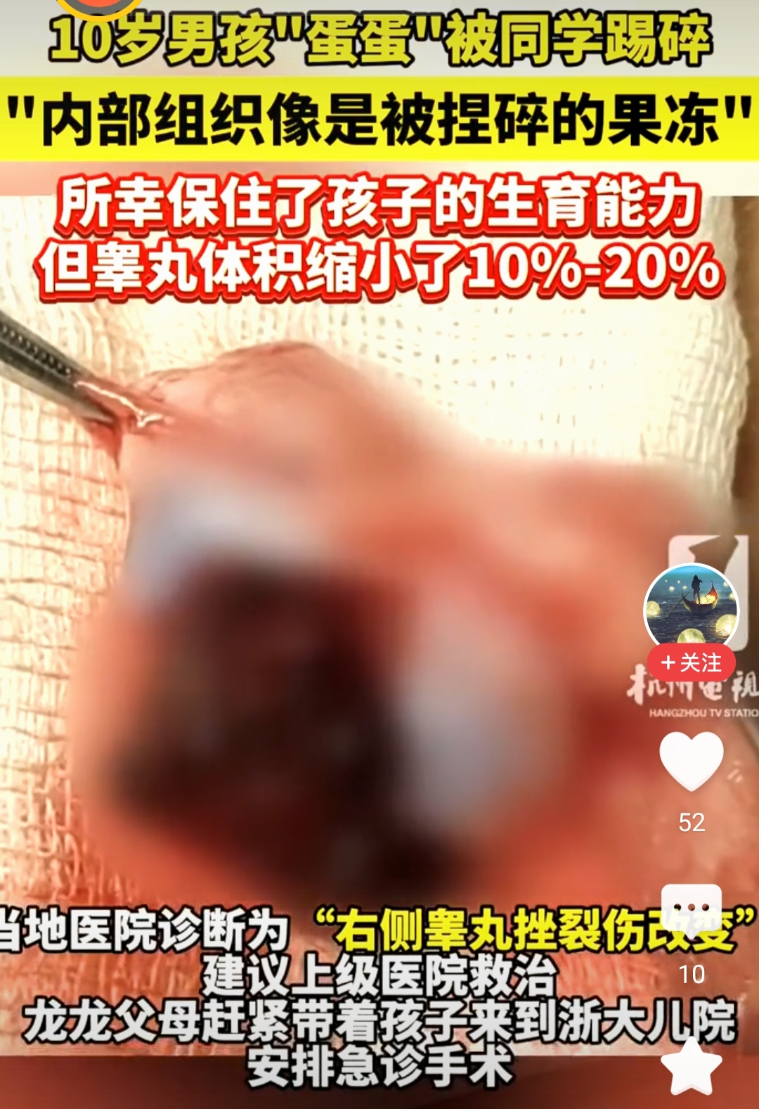 10岁男孩睾丸被踢碎,内部组织像捏碎的果冻 前段时间,10岁的龙龙课间