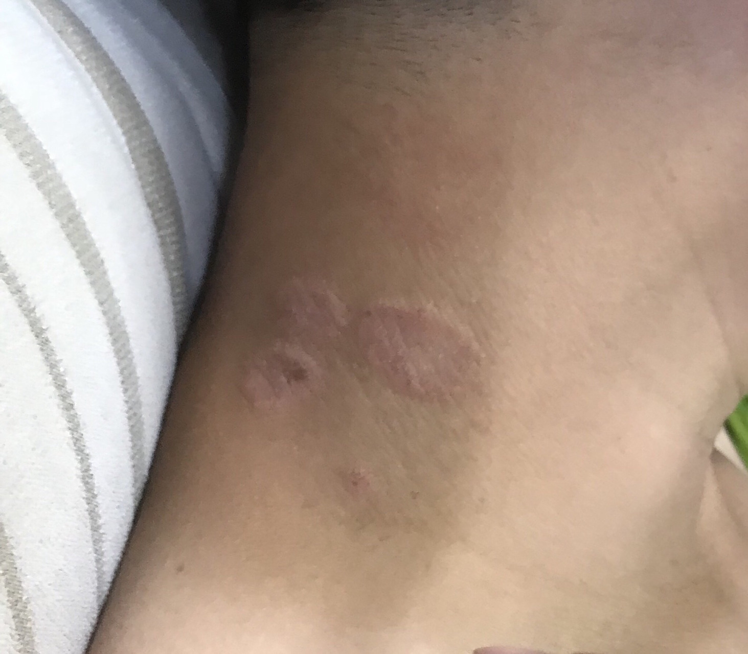 脖子长了三处癣,怎么办