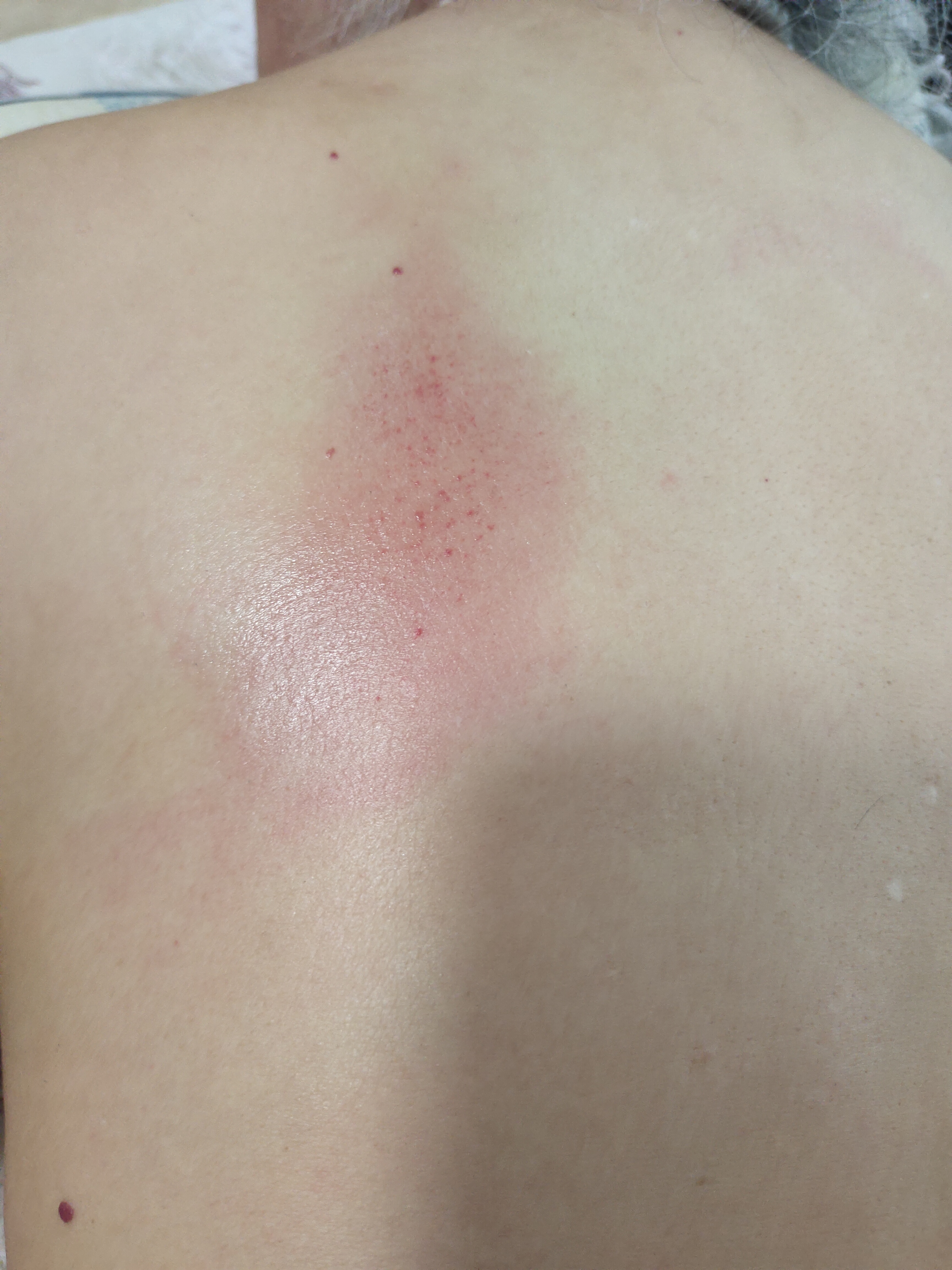 处理之后,母上大人说能吸气,打哈欠了,之前吸气只能