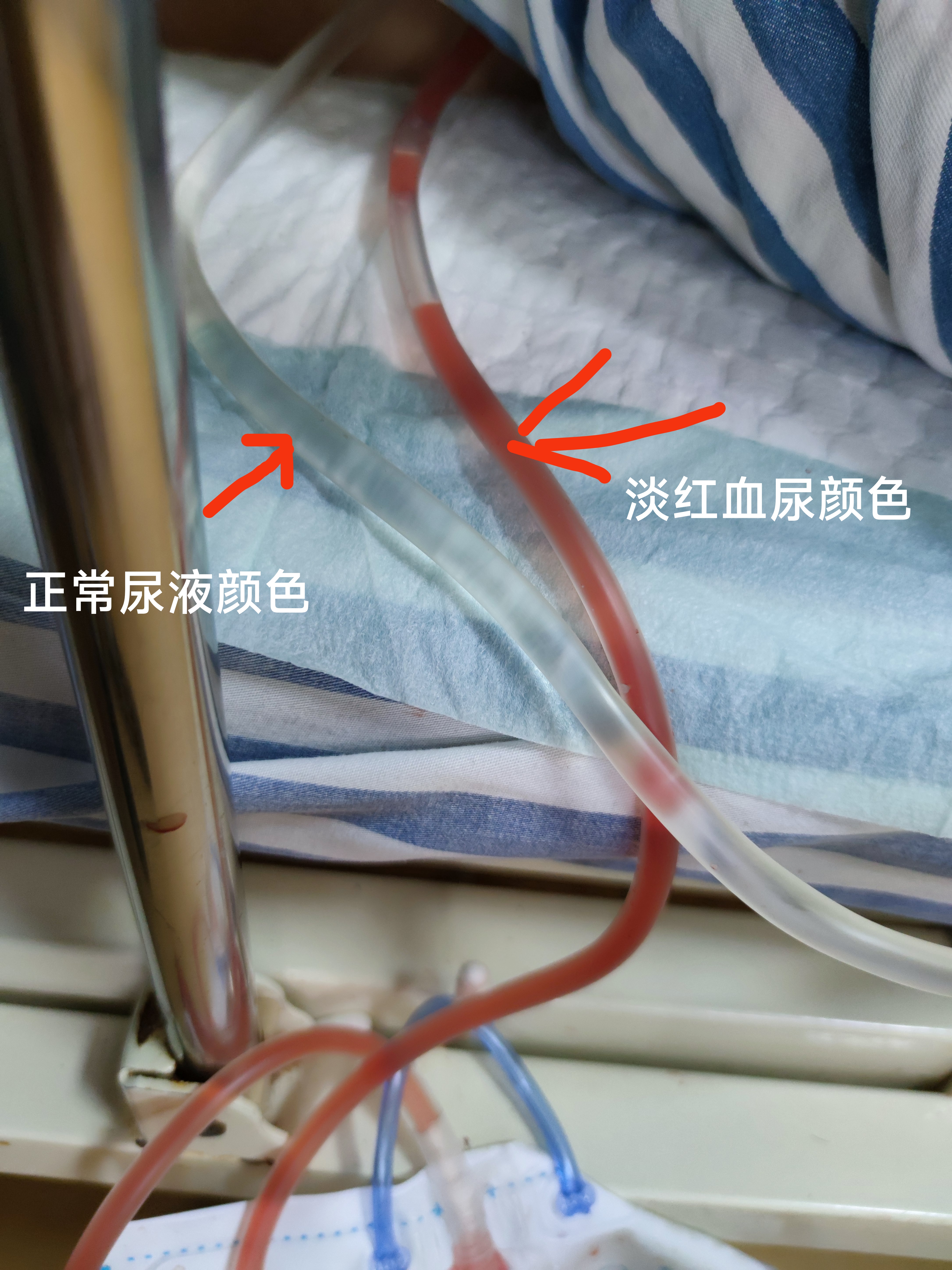 怎么判断自己尿血肾造瘘管渗血血尿的颜色有哪些尿血图片尿袋有血图片