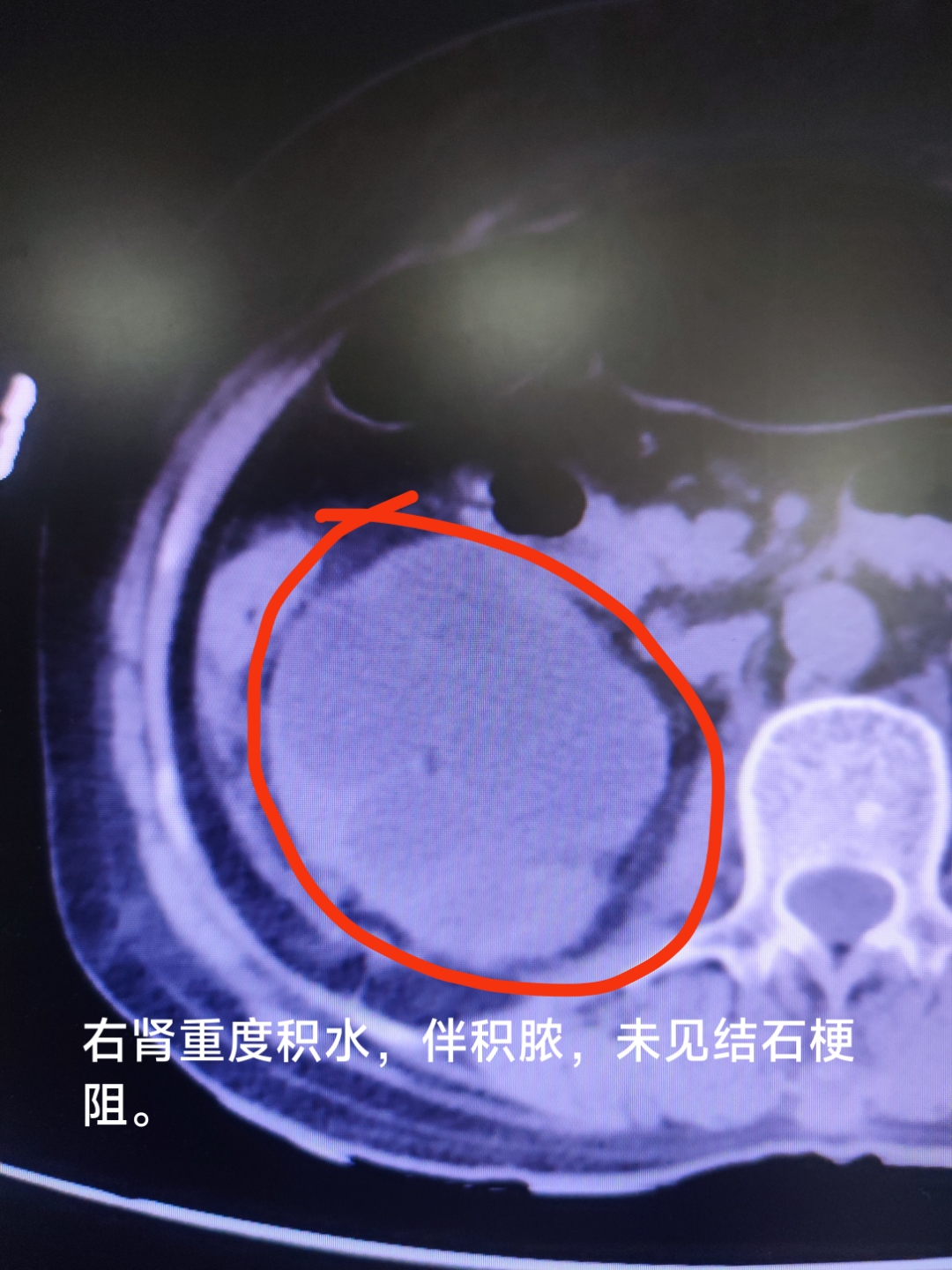72岁阿姨,右腰部胀痛伴有发热入院,腹部ct见右肾有重度积水