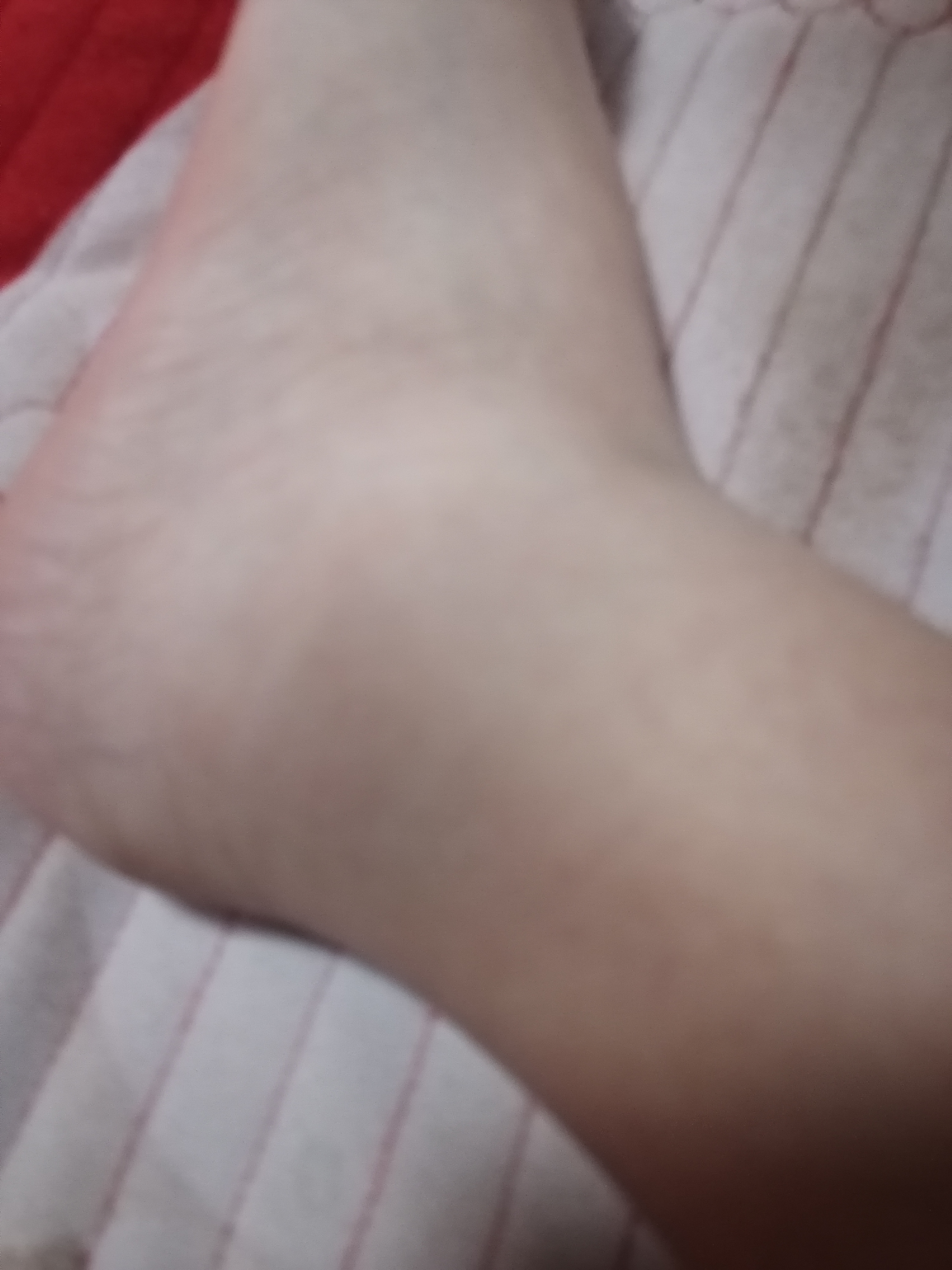 脚腕扭伤,该怎么治疗?