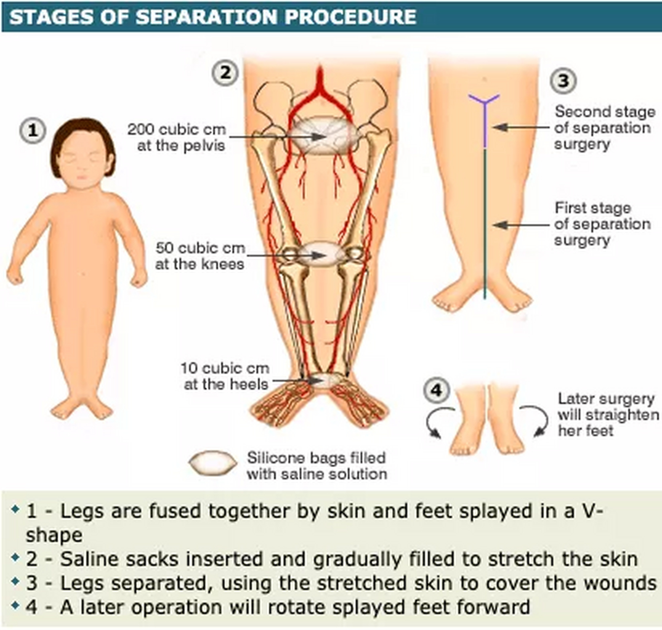 世上真的有美人鱼,有一种先天疾病叫" 美人鱼综合症",是一种罕见的
