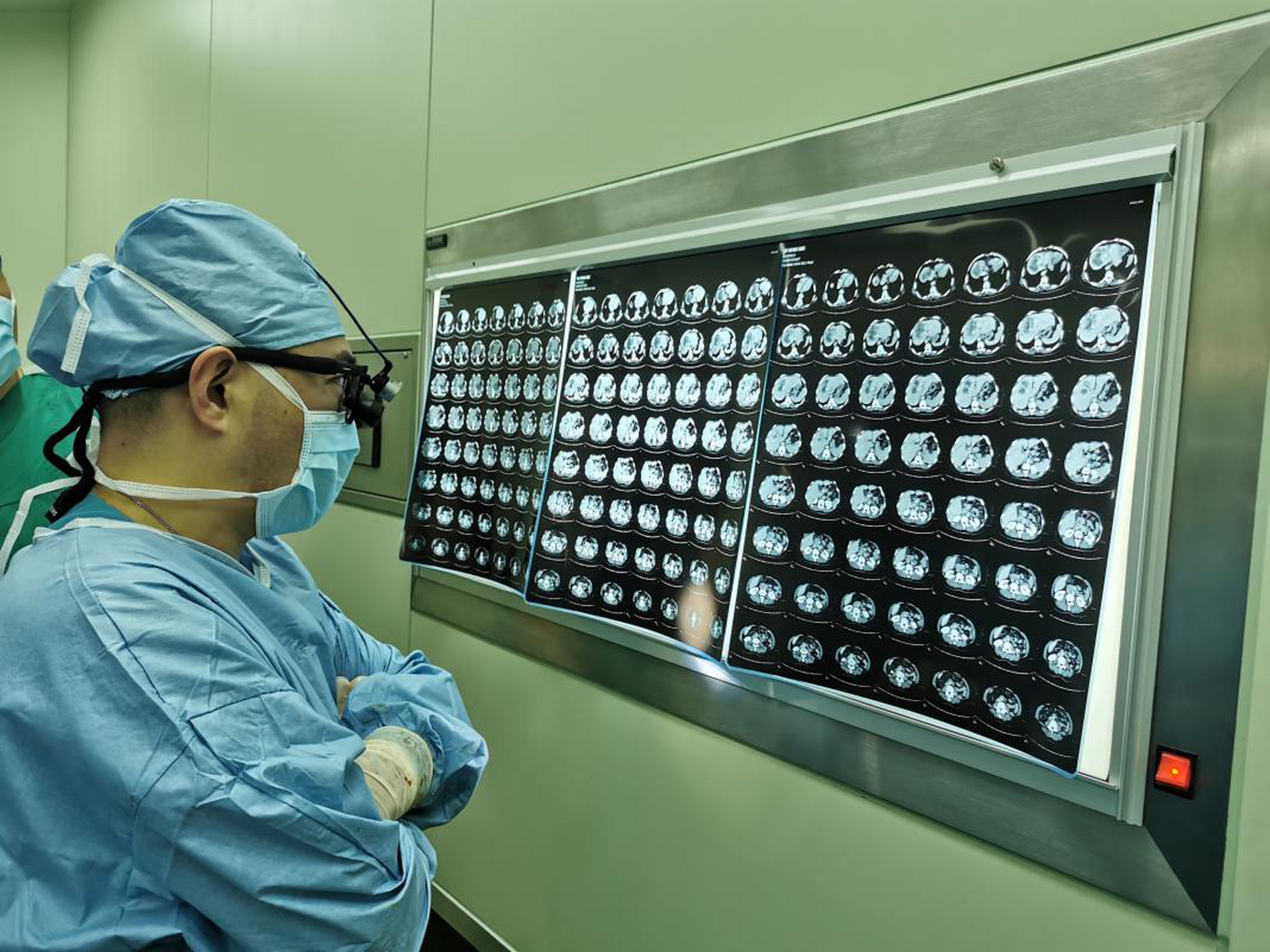 这台相当于肝移植的手术,在哈医大二院邰升教授主刀下成功实施!