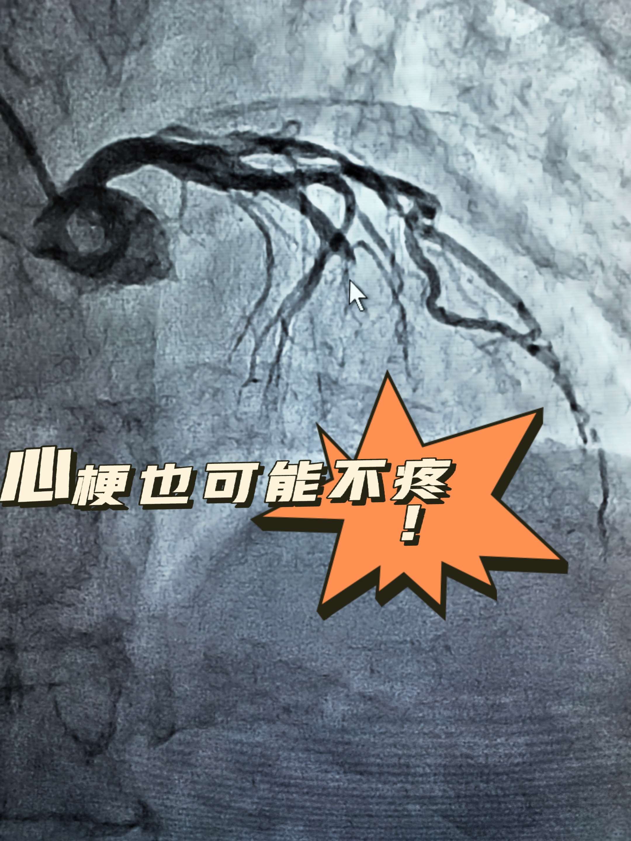 肾脏压力,未粘膜受损心梗一般多久死亡心脏血管球囊扩张能维持多久