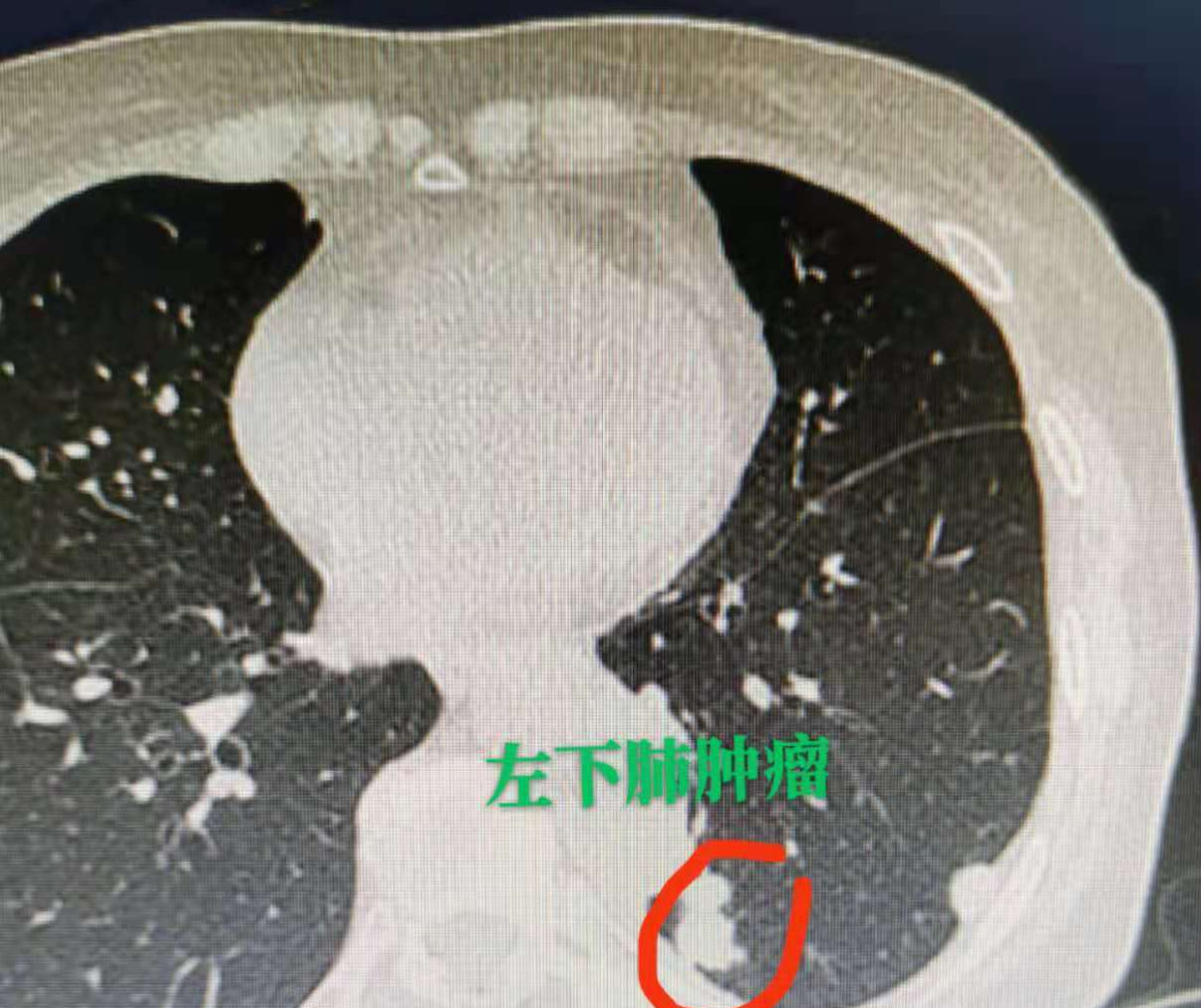 肺癌扩散图片图片