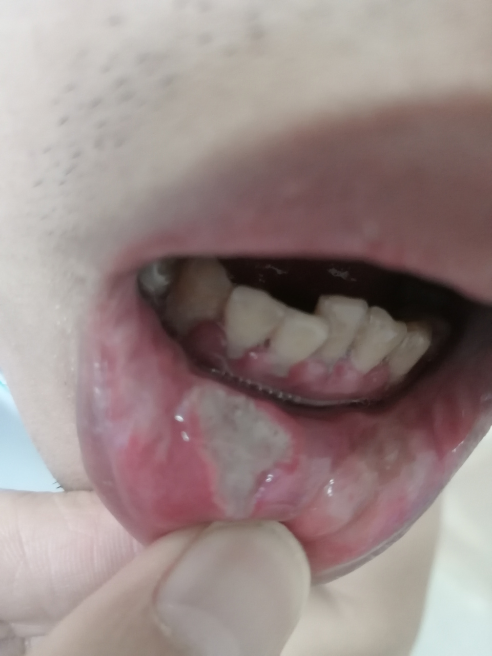 口腔溃疡图 恶性图片