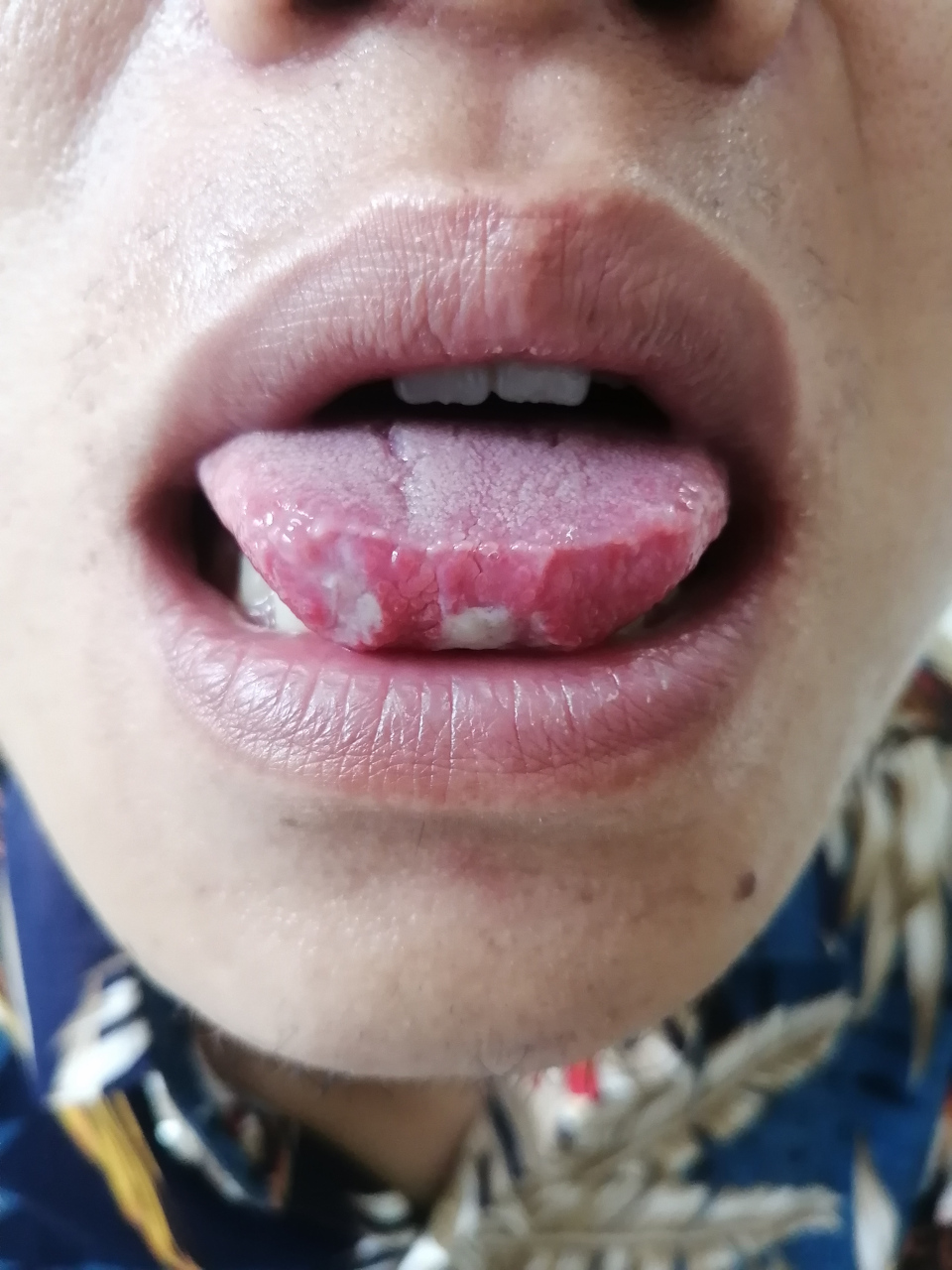 新乡市老中医看烂嘴图片经验分享,口腔溃疡就是烂嘴,口腔是消化的第一