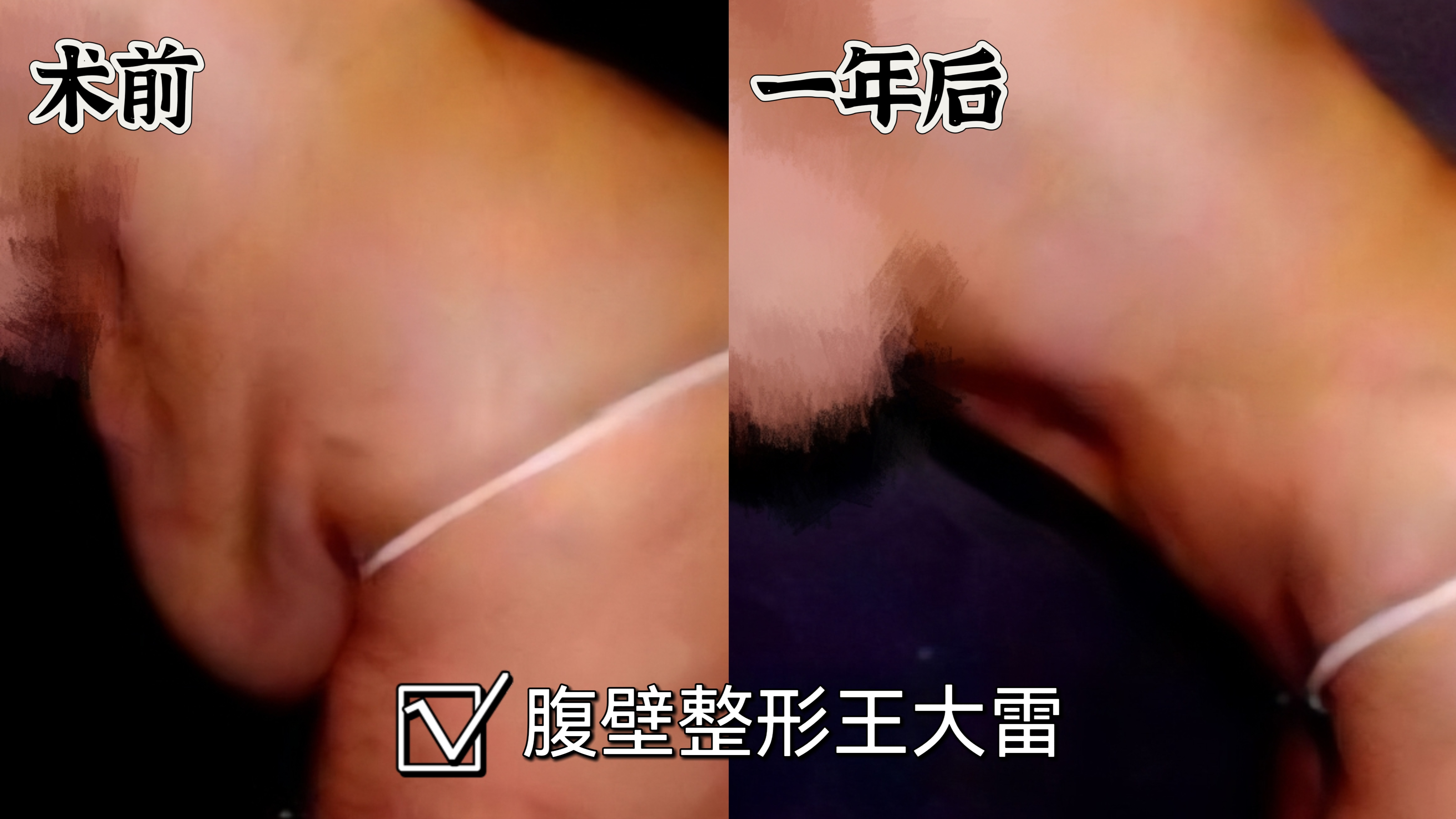 分享一组腹壁整形术后1年的恢复照片 这位患者63岁,皮肤状态保持很好