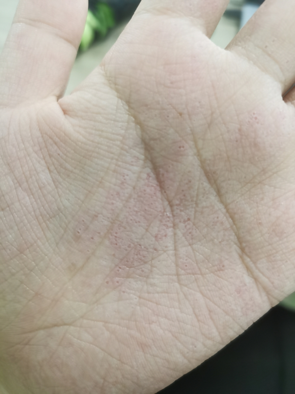 手掌上面有很多小洞洞是怎么回事呀 求解
