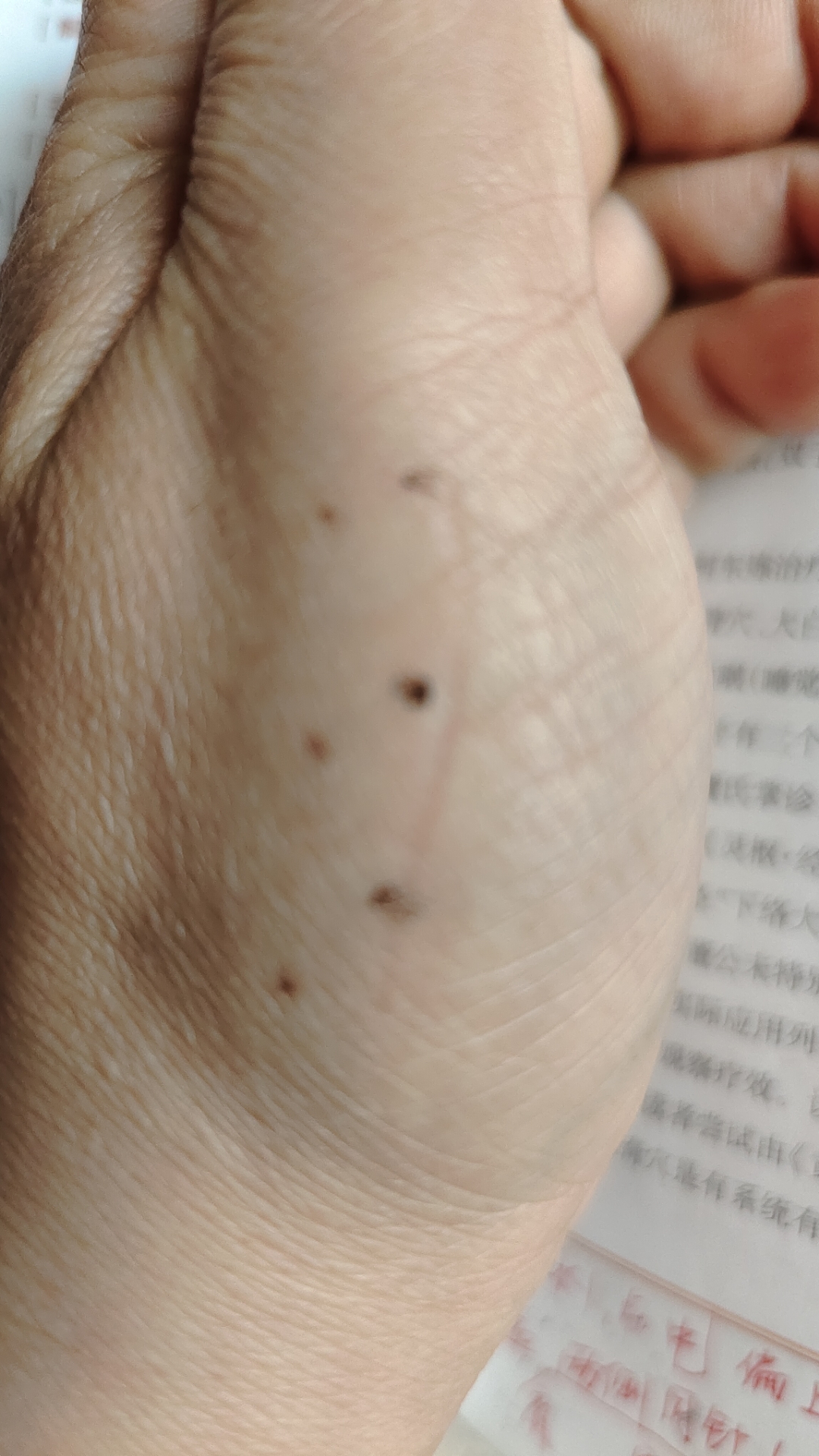 土水穴位于拇指第一掌骨内侧,第一掌骨中间一穴,前后五分各一