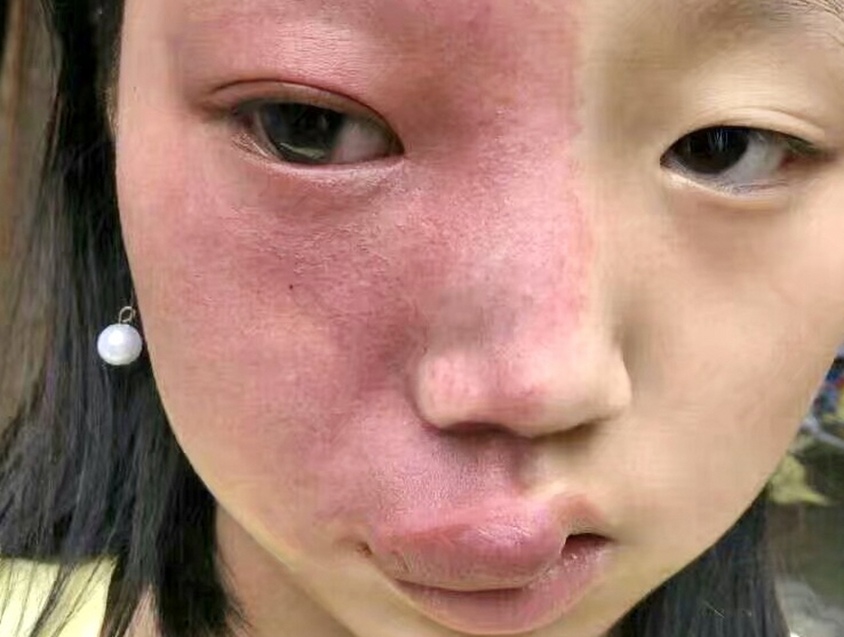 鲜红斑痣,又叫做红胎记,葡萄酒色斑,是一种真皮浅层的微静脉血管