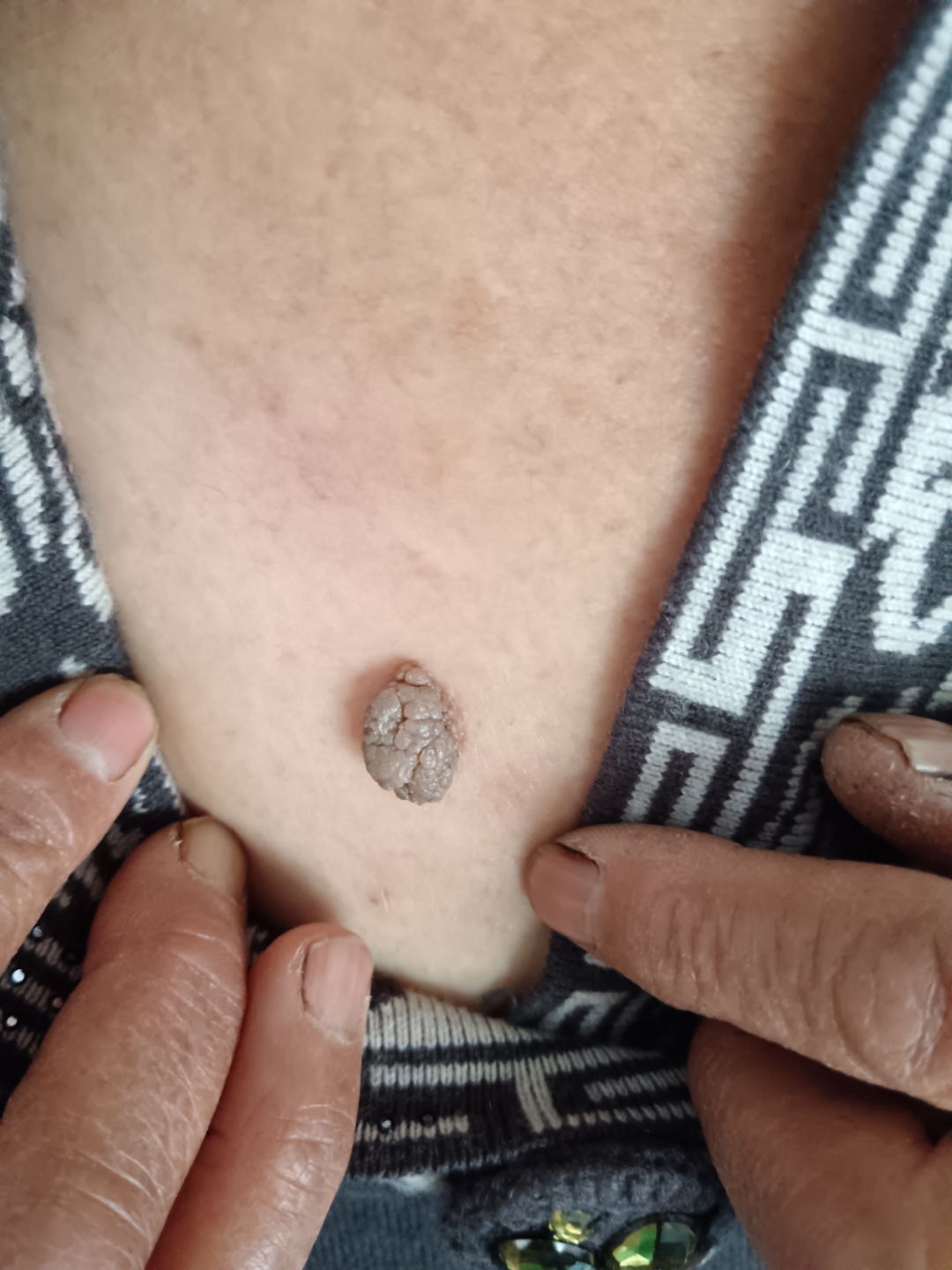 身上长肉球的话,必须马上除掉,要不后果不堪设想,以后会变成什么样?