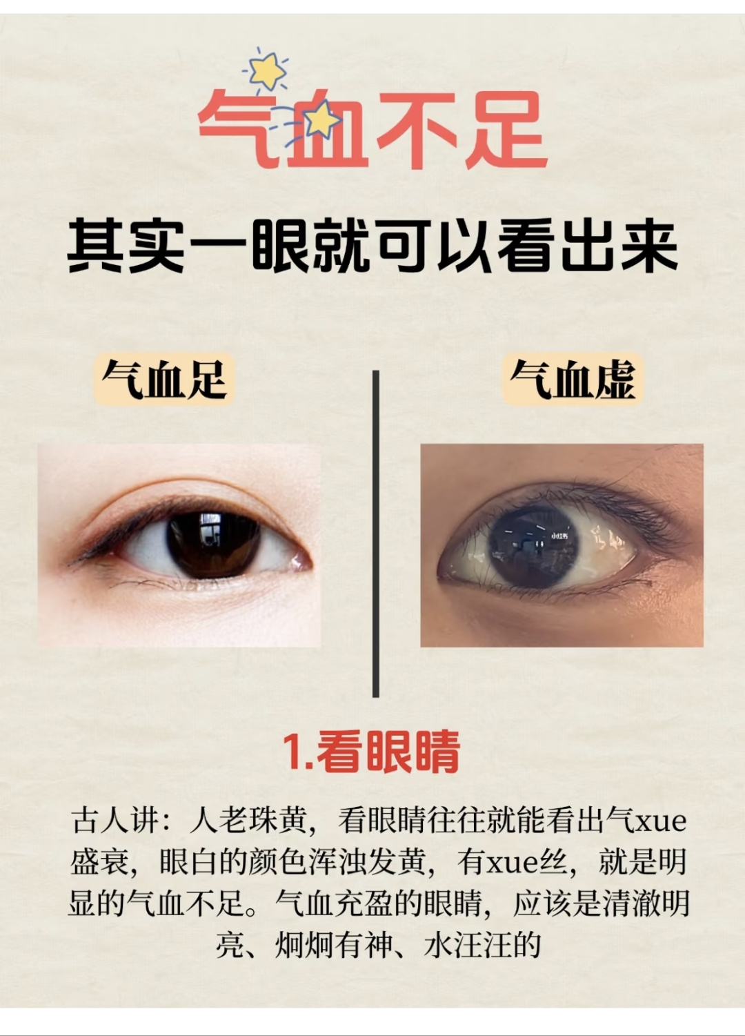 气血不足看眼睛:眼白浑浊发黄有血丝,气血足则清澈明亮有神