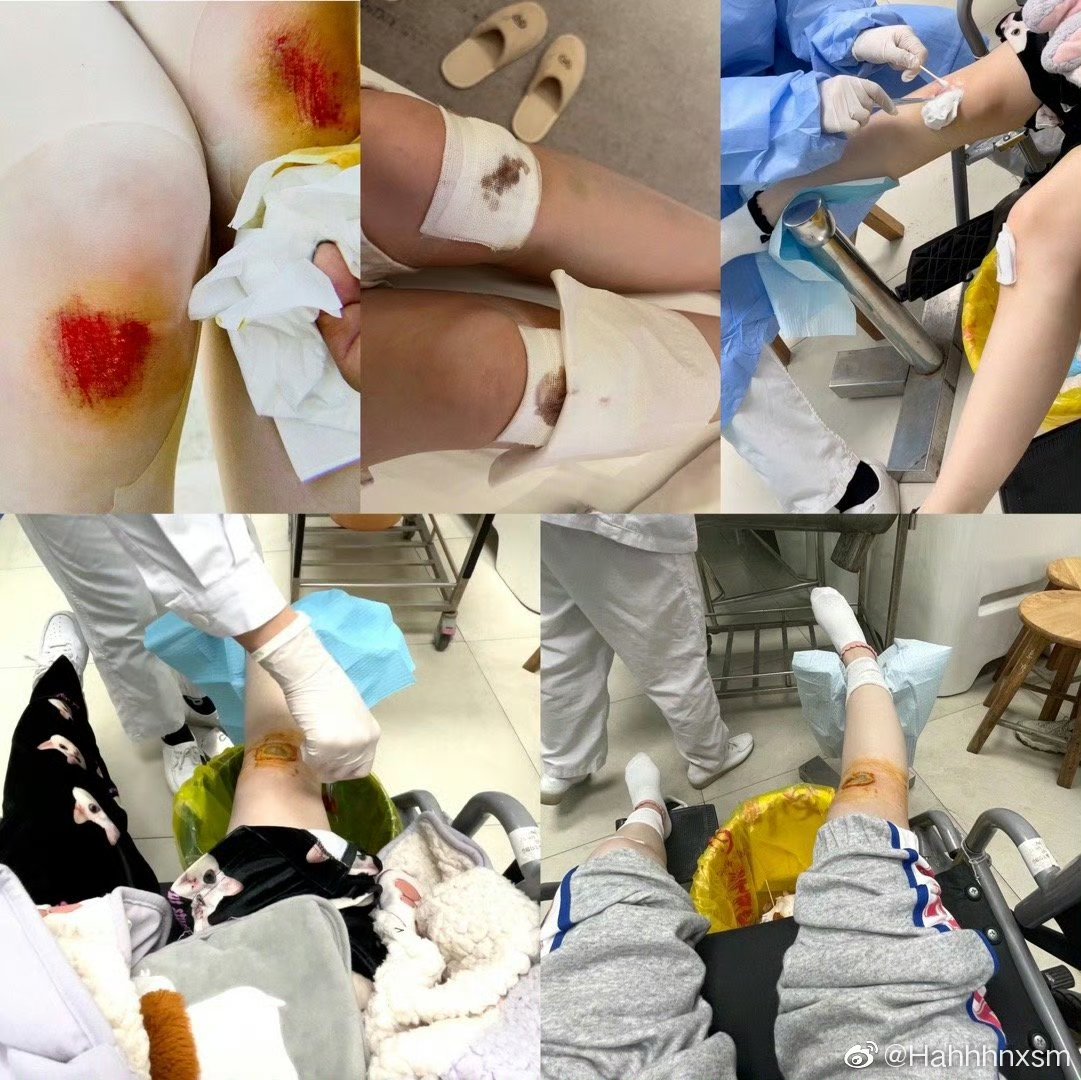 都这样了还说矫情 当时小鞠在拍戏因为拍戏摔到了腿无法走路,为了不