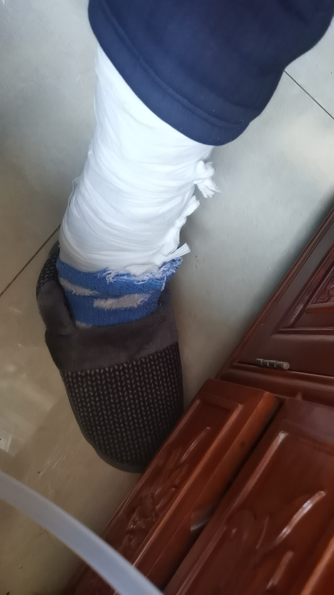 都骨折二次了!骨折复位成功,基本不疼了,养个半年就好了,哈哈