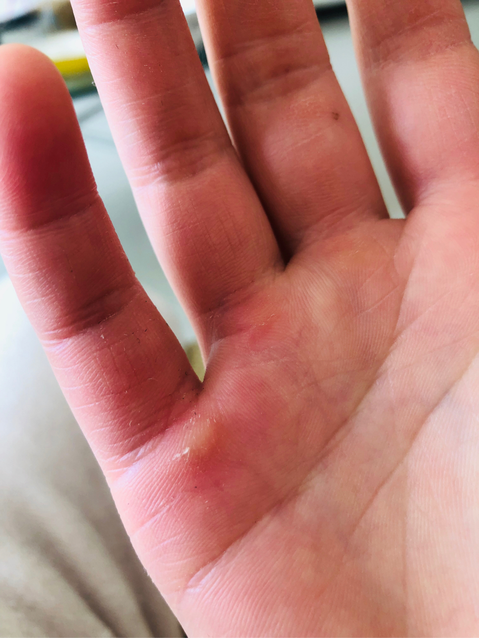 收拾卫生,手居然磨出茧子了.