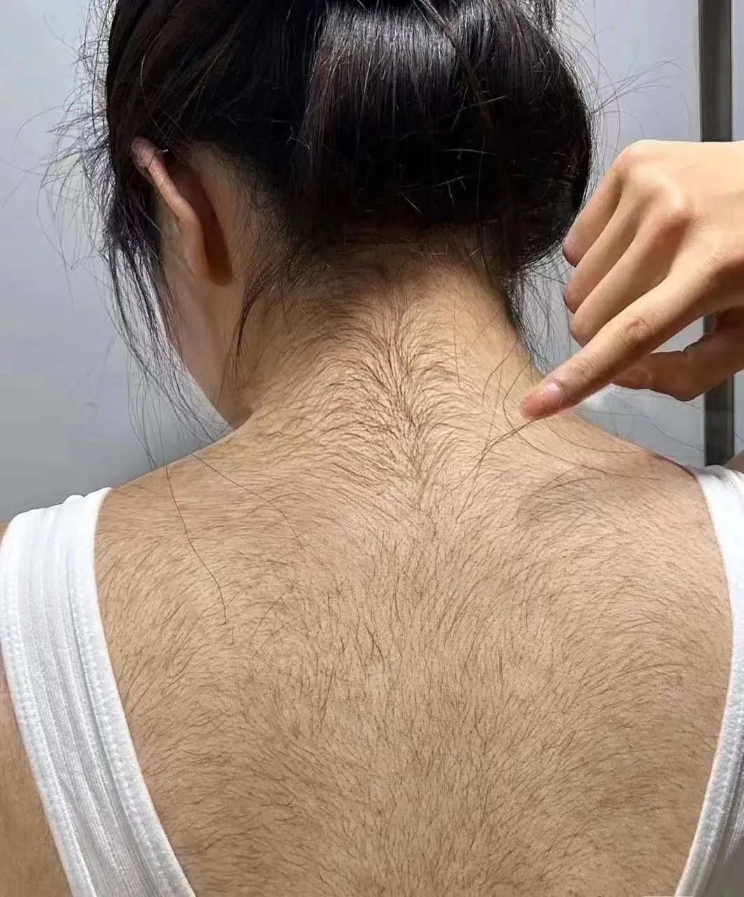 女性雄性激素分泌旺盛就是这样的结果