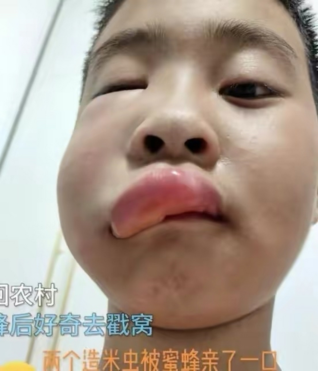 【男孩好奇捅蜂窝被蜜蜂蛰,网友:亲妈都不认识他了】  近日,一位妈妈