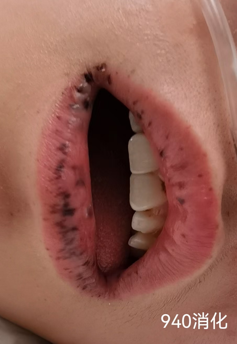 谁能想到嘴唇长黑斑竟然和多发肠息肉有关系? 患者为女性,目前19岁