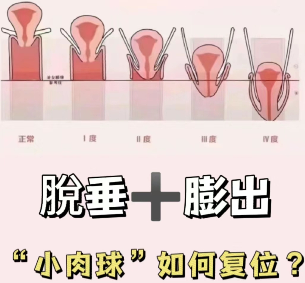 脱垂膨出#产后修复# #宝妈# #产后子宫脱垂# #产后漏尿