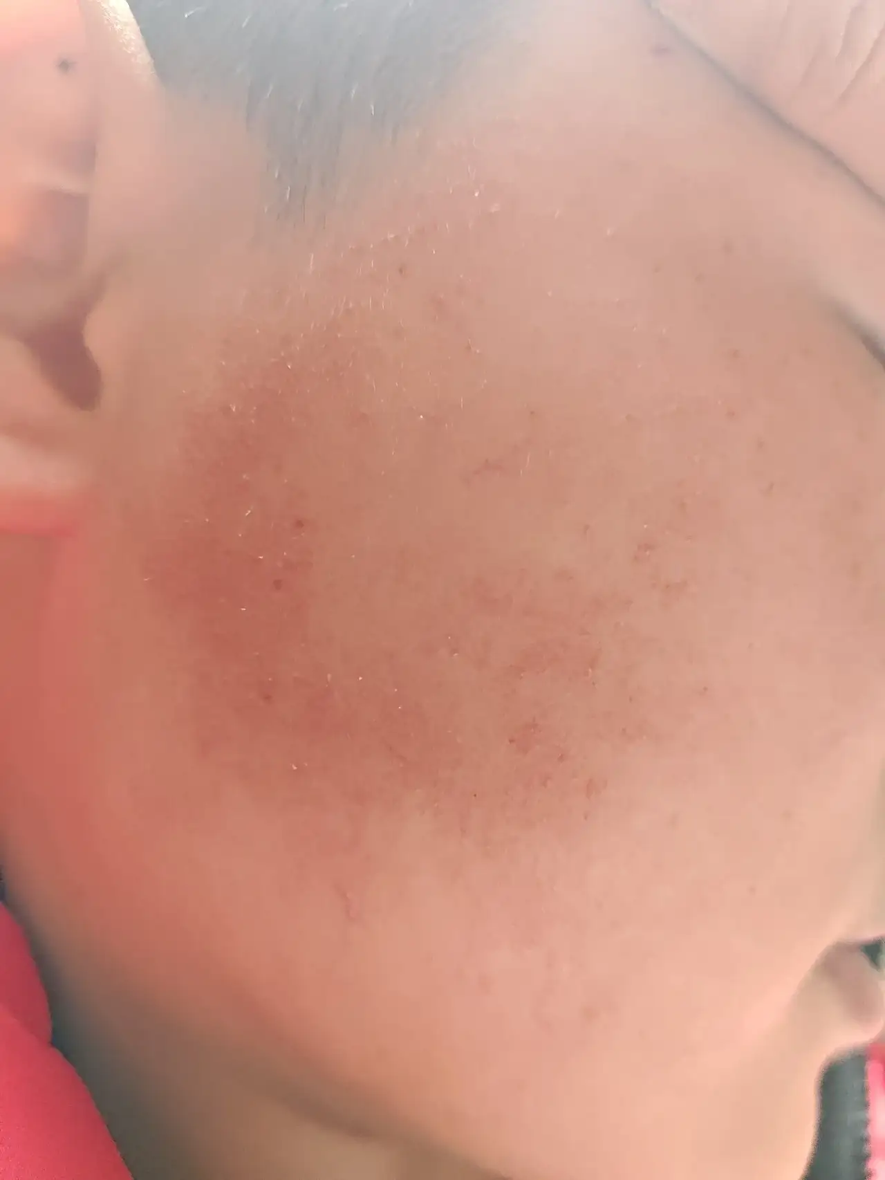 仔细瞧那些痘痘,小小的,红红的,零零散散地分布在孩子脸上,看着就让人