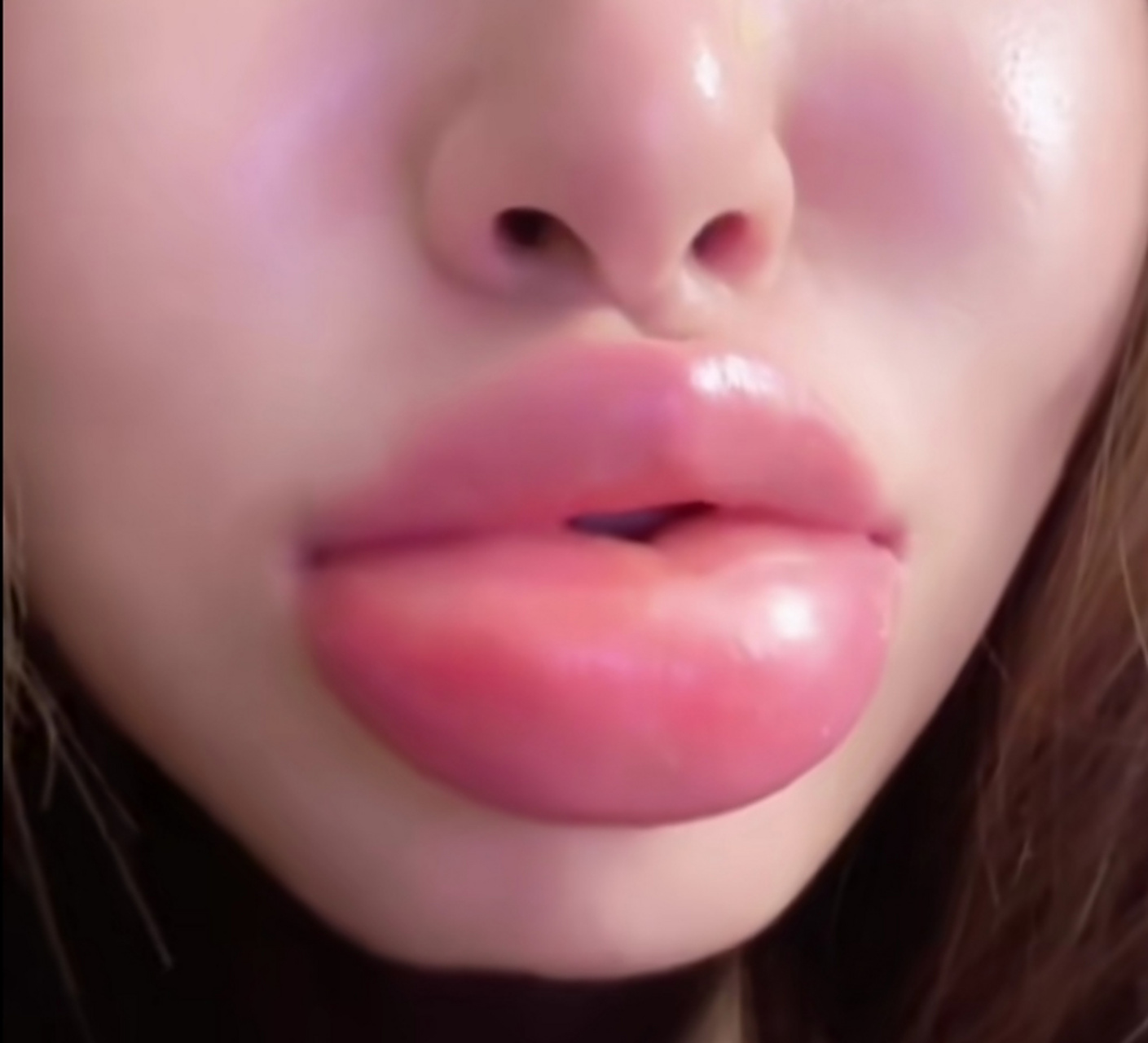 她吃完田螺后嘴肿成香肠嘴,有可能是田螺没洗干净,导致细菌感染.