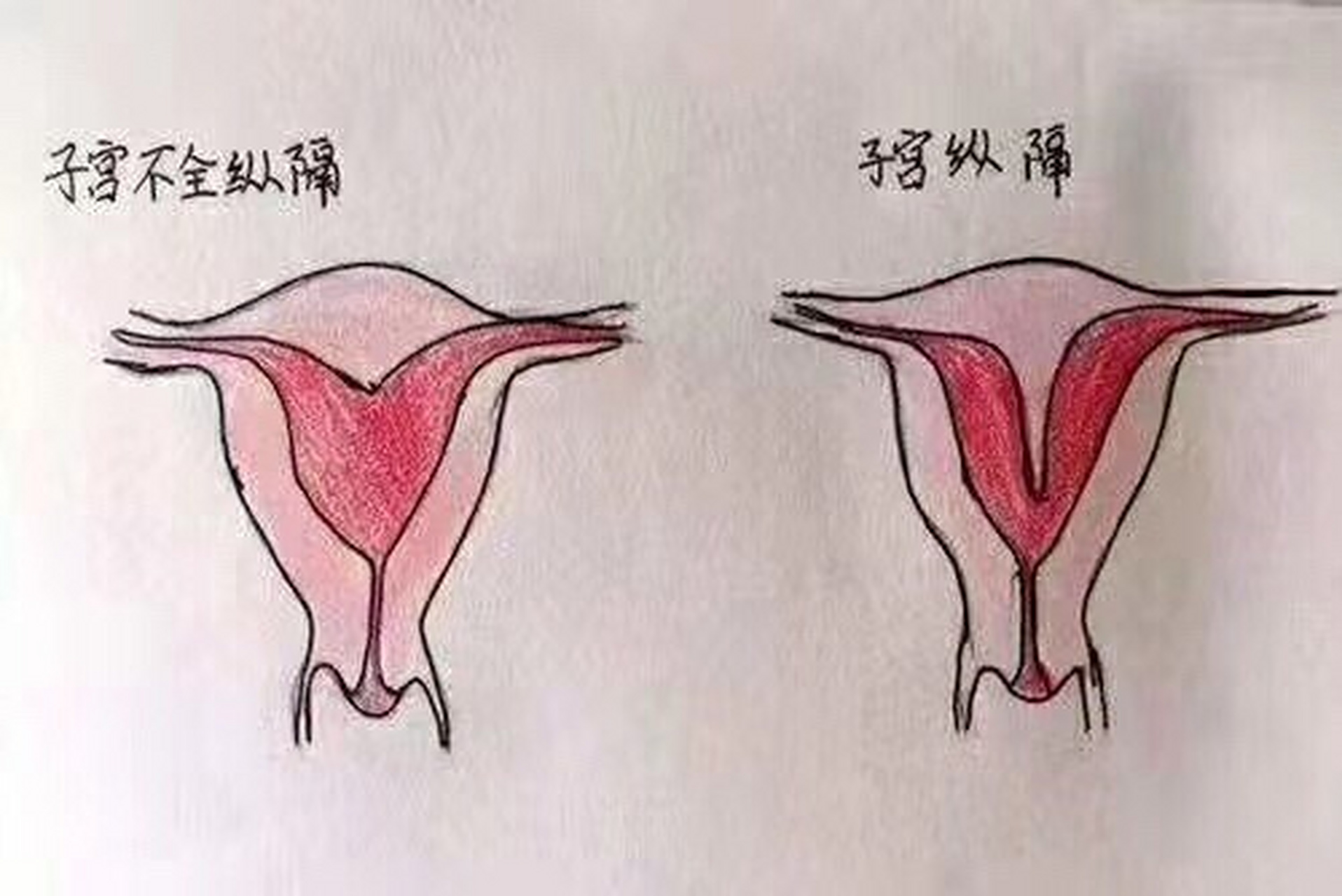 富有!子宫畸形是怎么回事"一马当先"-第1张图片-丸子博客