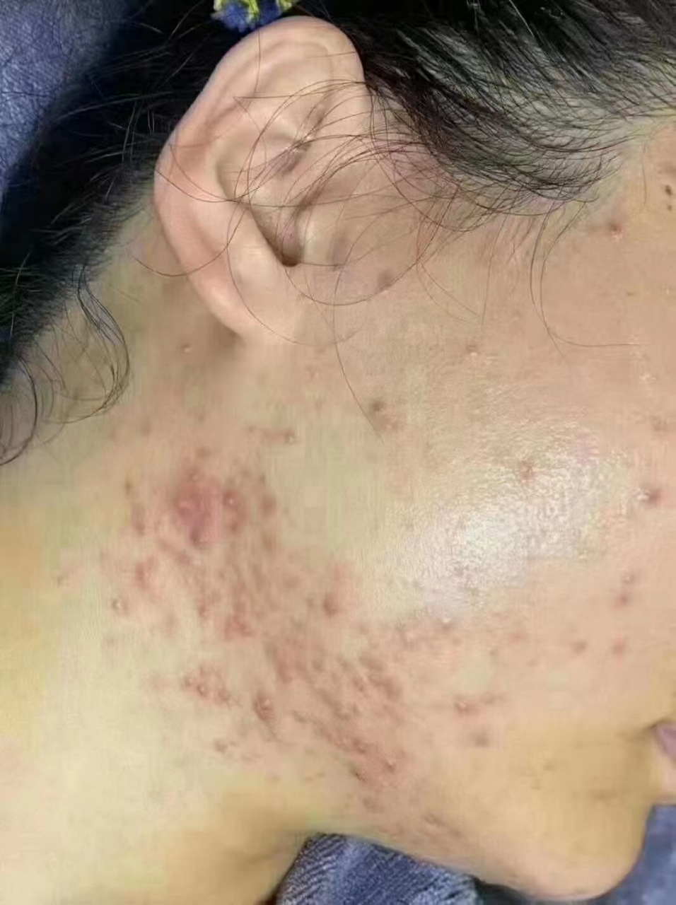 痘痘会传染吗? 答案:会 痘痘不治疗会越长越多吗? 答案: 会