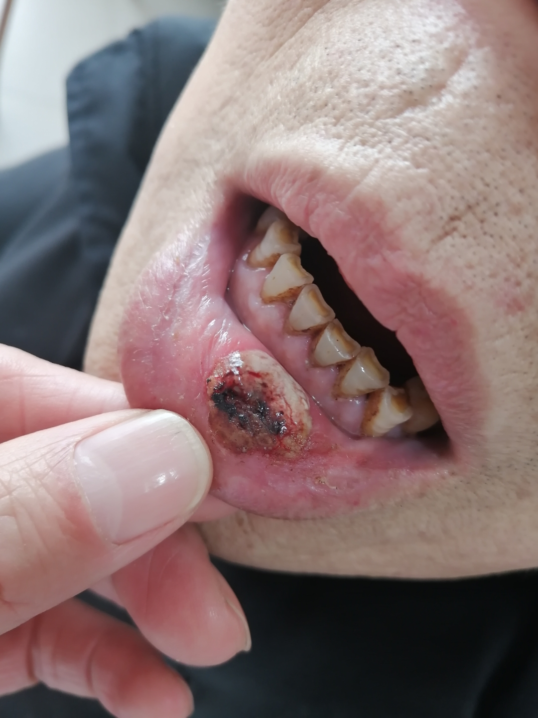 各位看客,看看哥的嘴烂了!