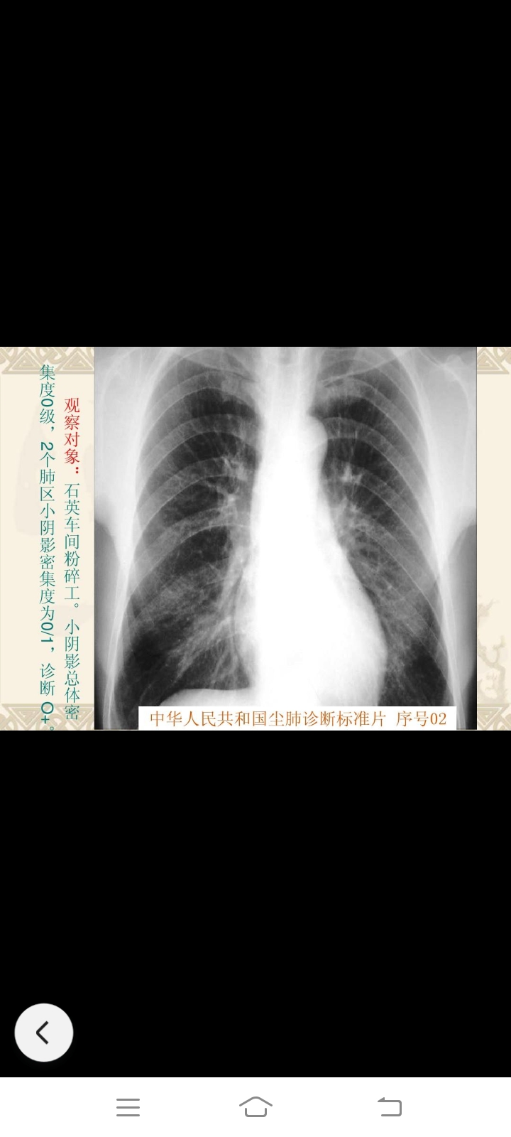 尘肺标准片26张图片图片