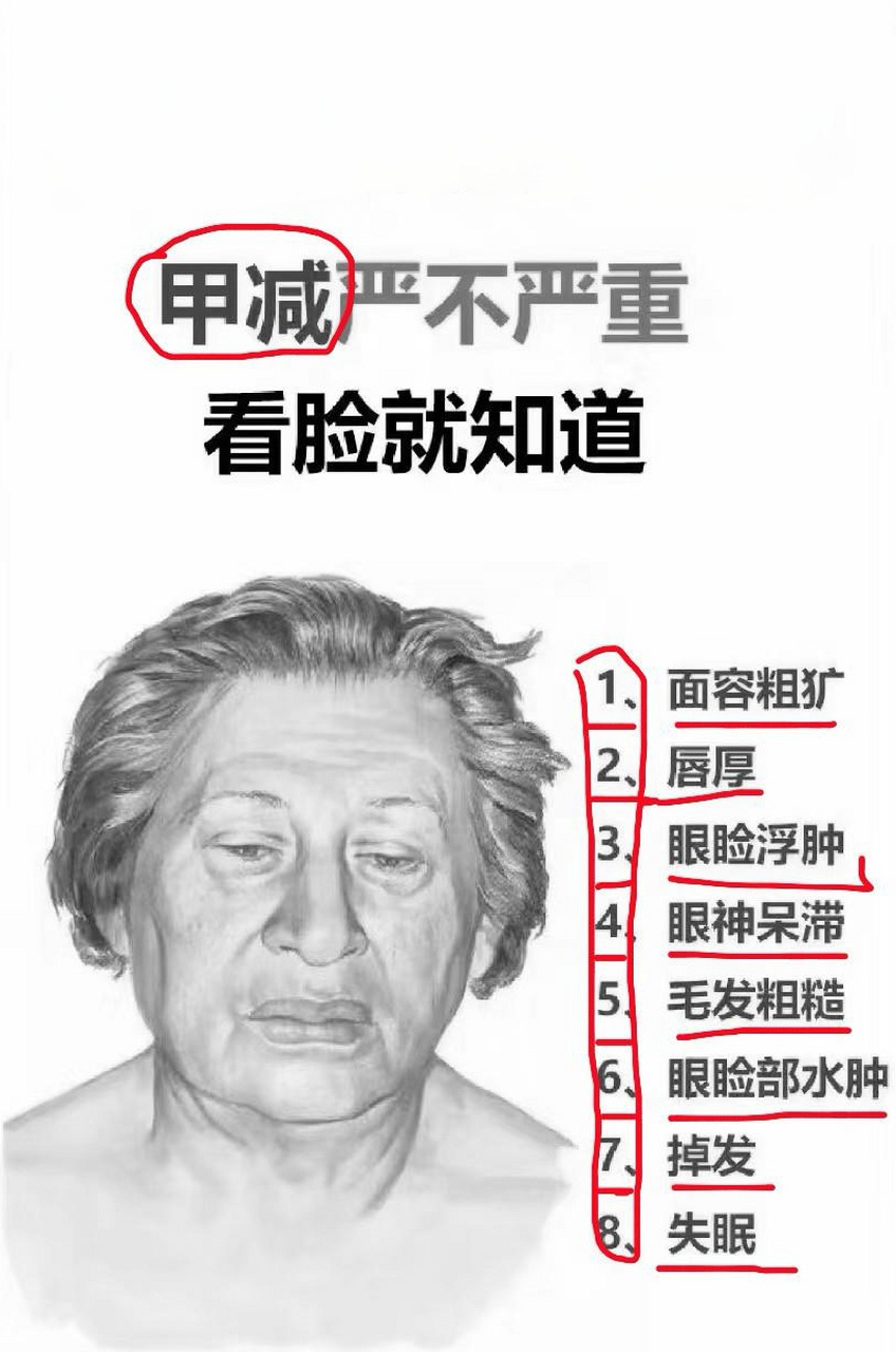 从面部看"甲减"#健康管理