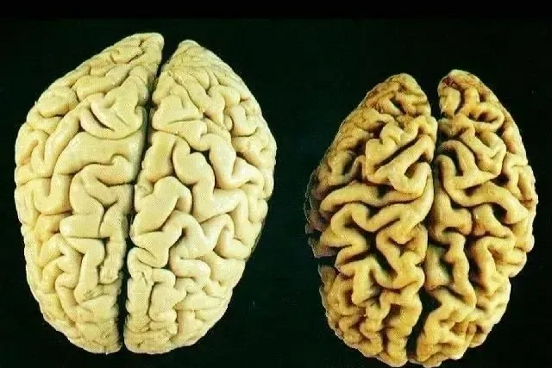 正常大脑和阿尔茨海默症患者的大脑,看看有啥区别?