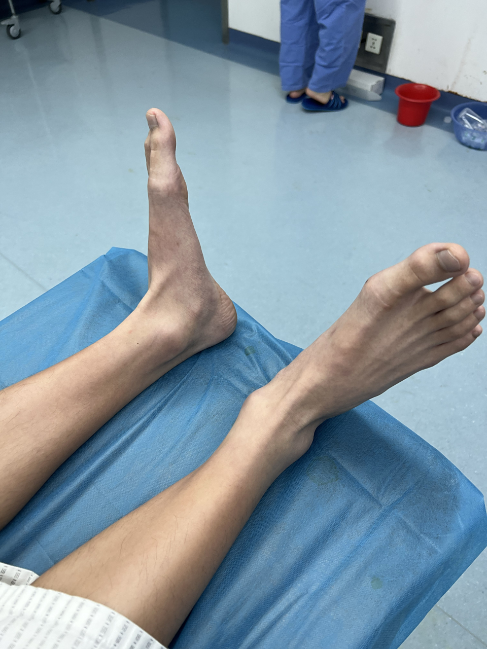 16岁男孩的扁平足(足外翻),只有父亲一人认为他的脚需要治疗,连男孩