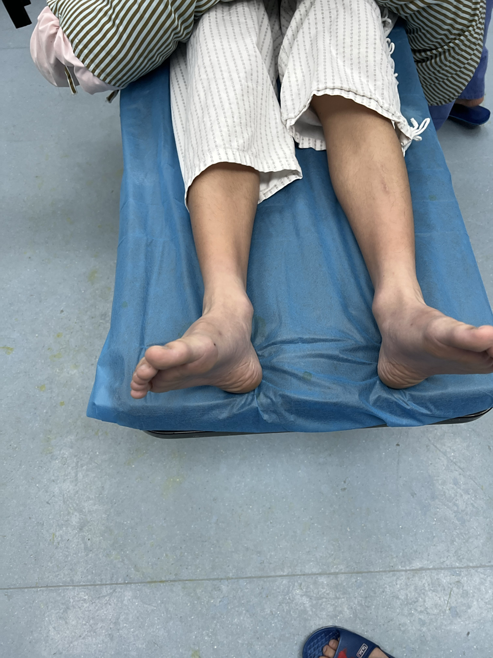 16岁男孩的扁平足(足外翻),只有父亲一人认为他的脚需要治疗,连男孩