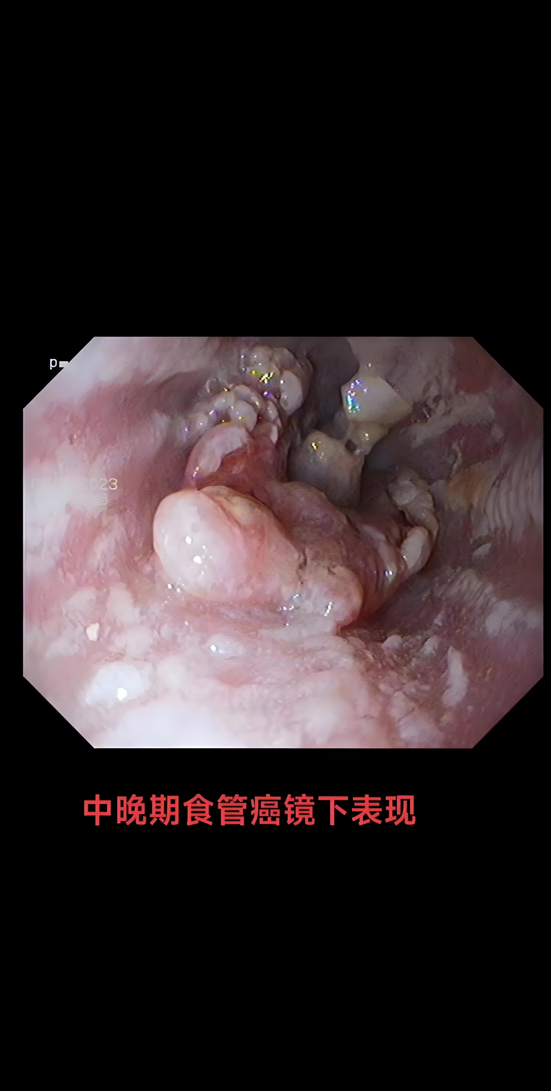 寻找民间中医高手调理食道癌, 吞咽艰难,身心俱疲
