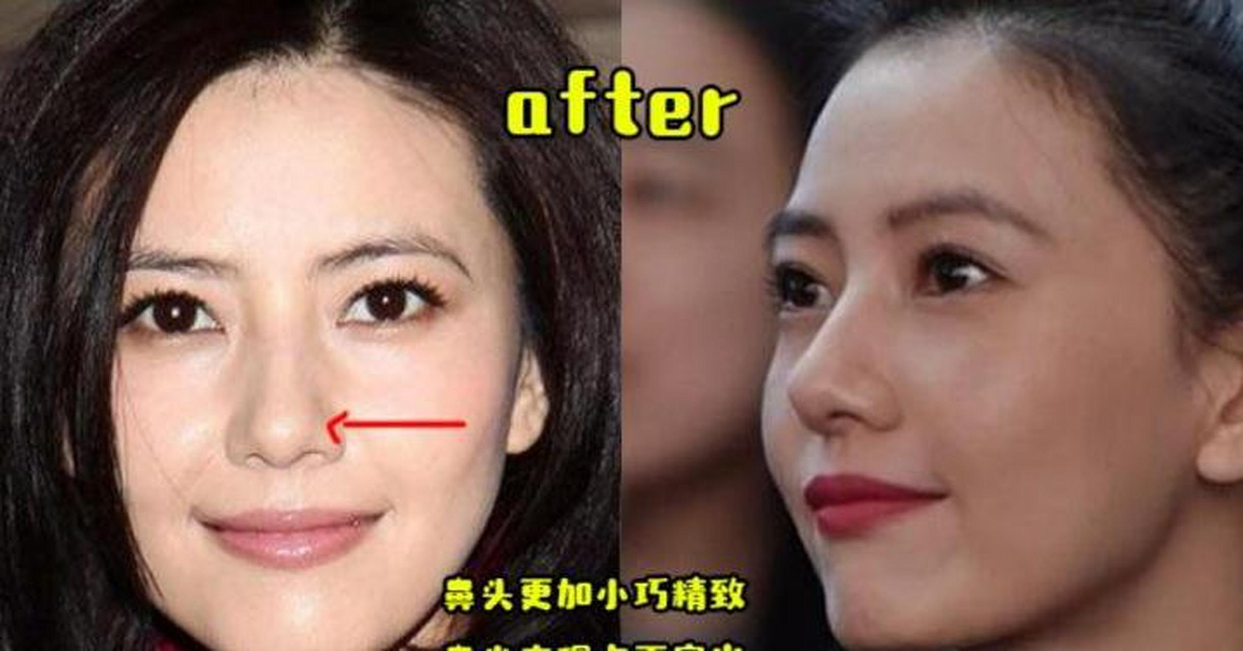 高圆圆微调 鼻头缩小前后对比!缩小后气质和颜值都有了!