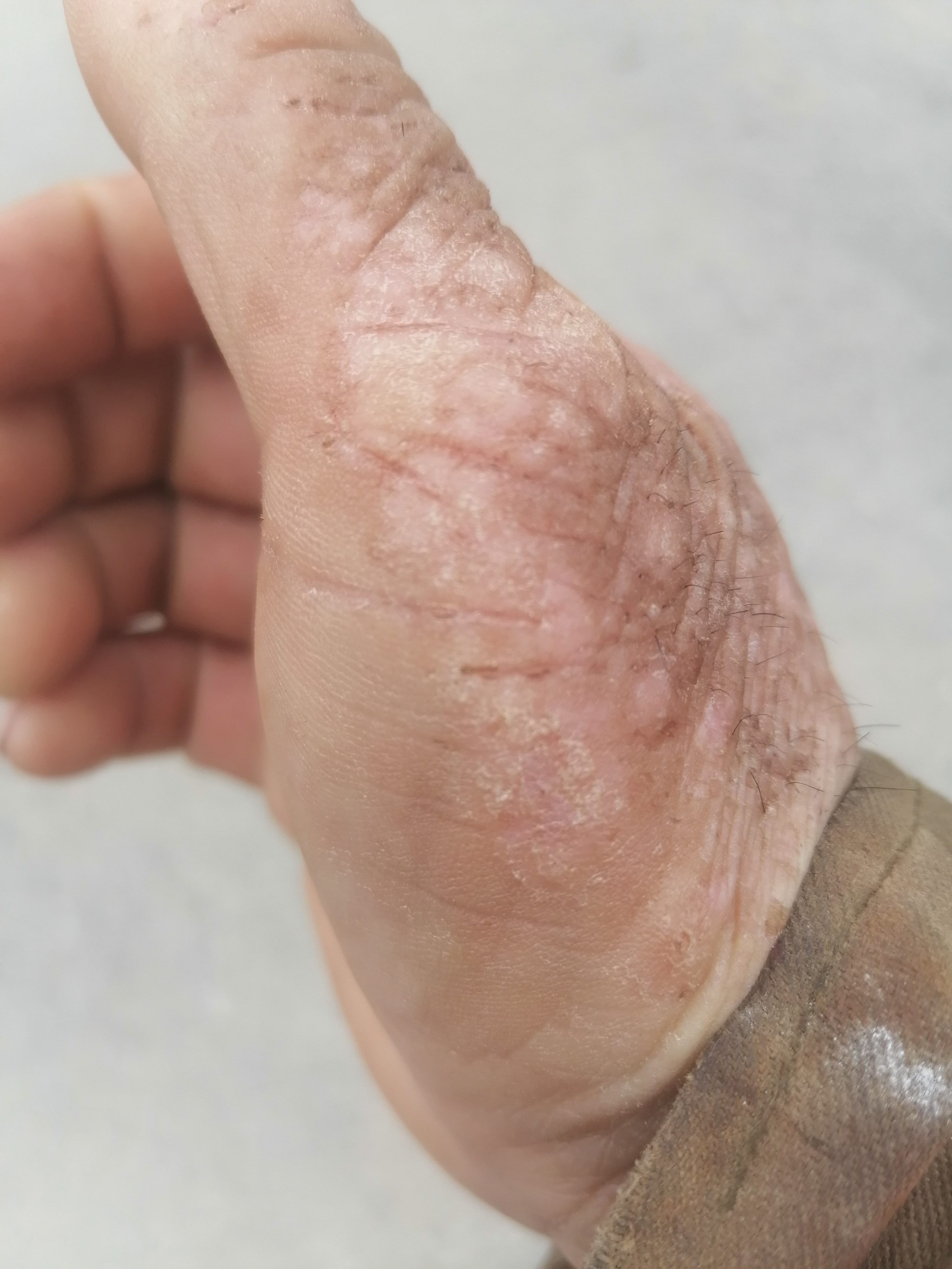 关爱皮肤健康 手部皮肤脂溢性皮炎就是痒痒的