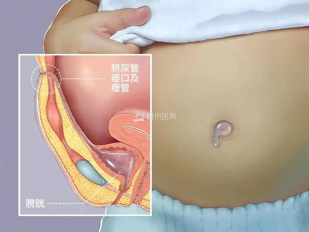 漏尿":脐尿管瘘  新生儿脐尿管瘘是一种罕见但可能出现的情况,导致