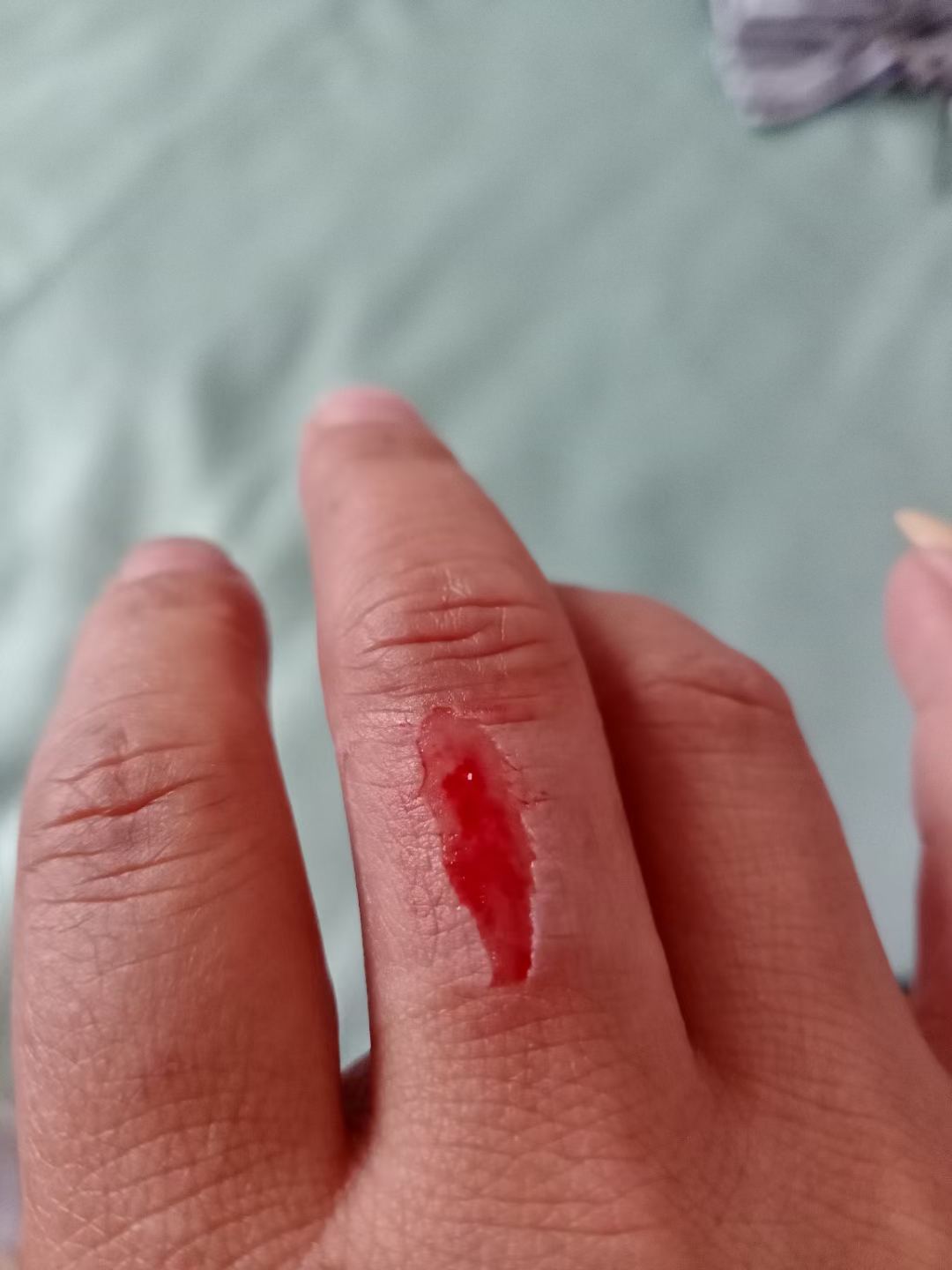 昨天搬货的时候不小心把手刮成这个样子,就这样忍痛又干了一上午活