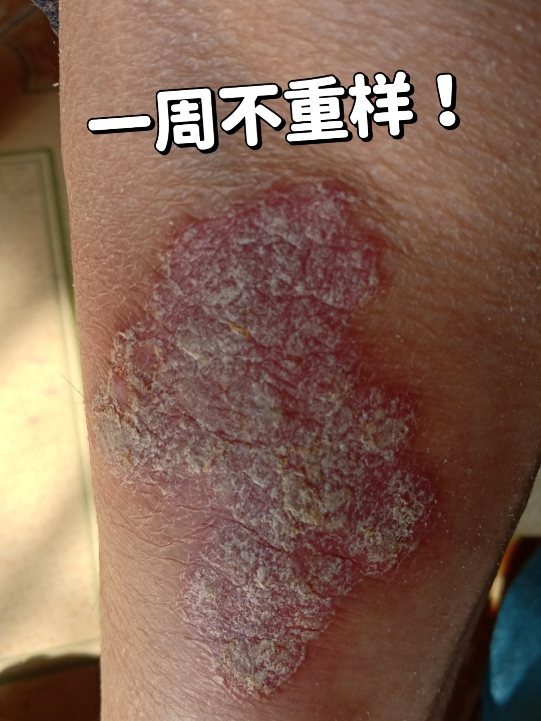 每天一个健康冷知识# 有福之人,皮肤病折磨人啊,血中有病毒,我在治疗