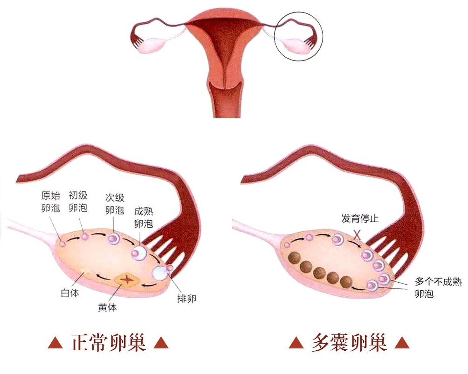 胰岛素抵抗与多囊卵巢图片