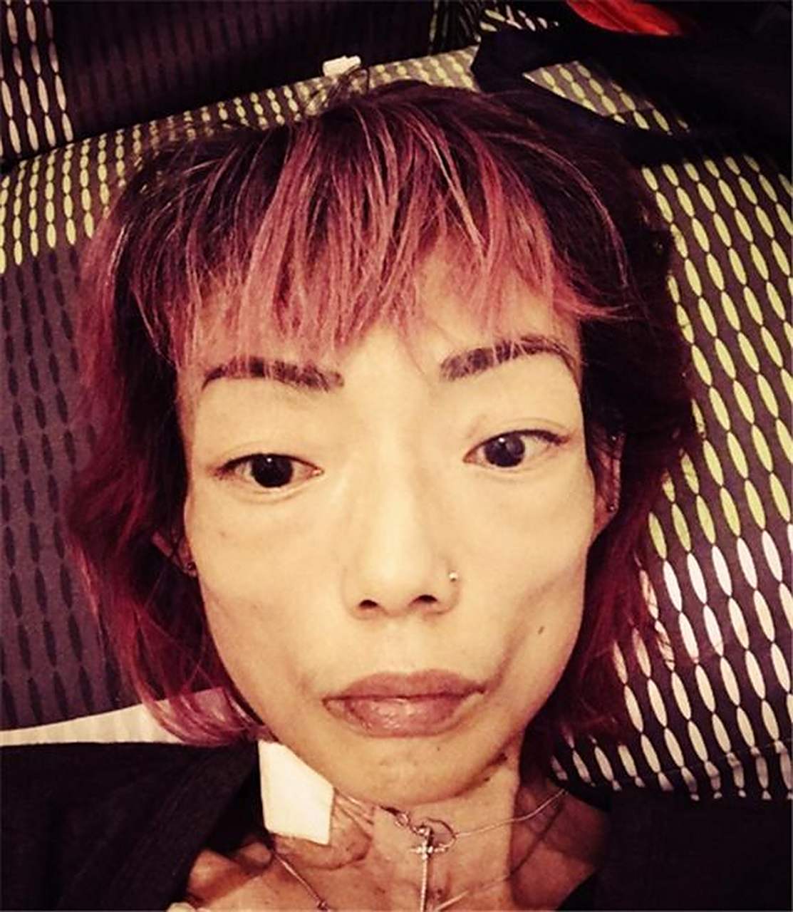 女主因为感情问题得了厌食症,之后就消瘦成这样子了.