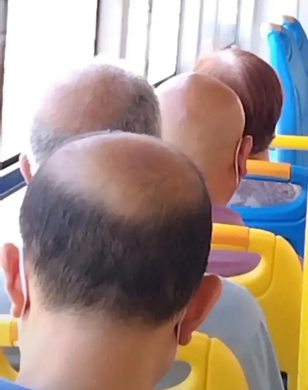 谢顶属不属于残疾