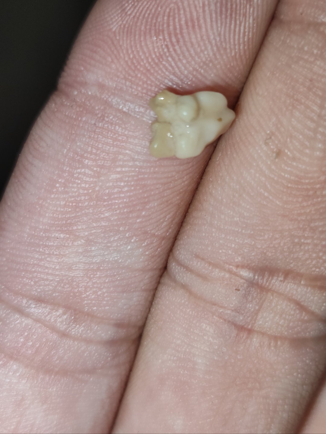 妈耶,天天刷牙还能从嘴里扣出这么大个扁桃体结石