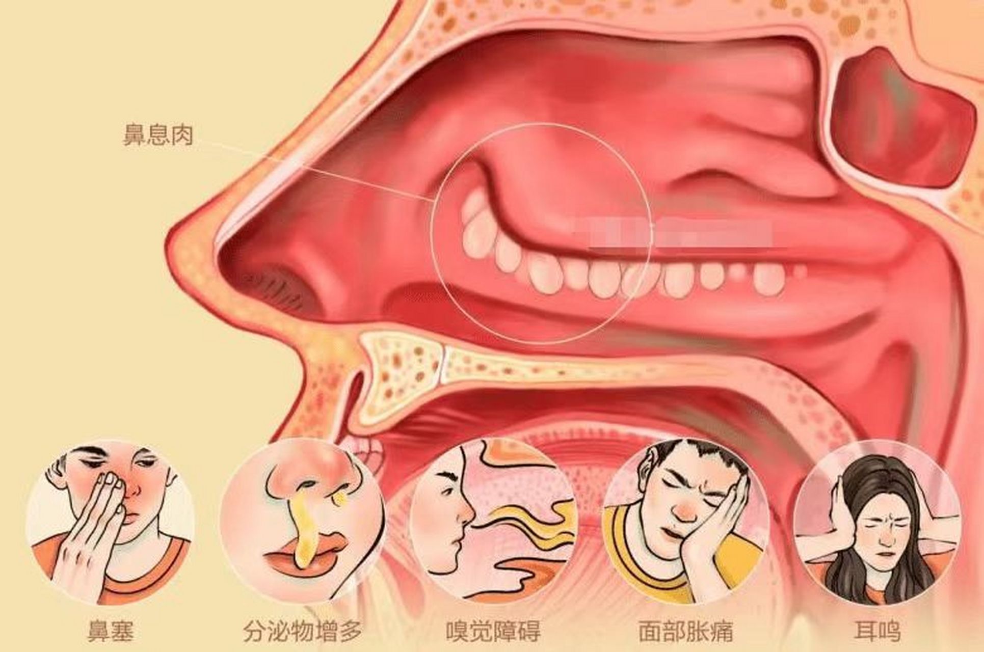 肺息肉图片